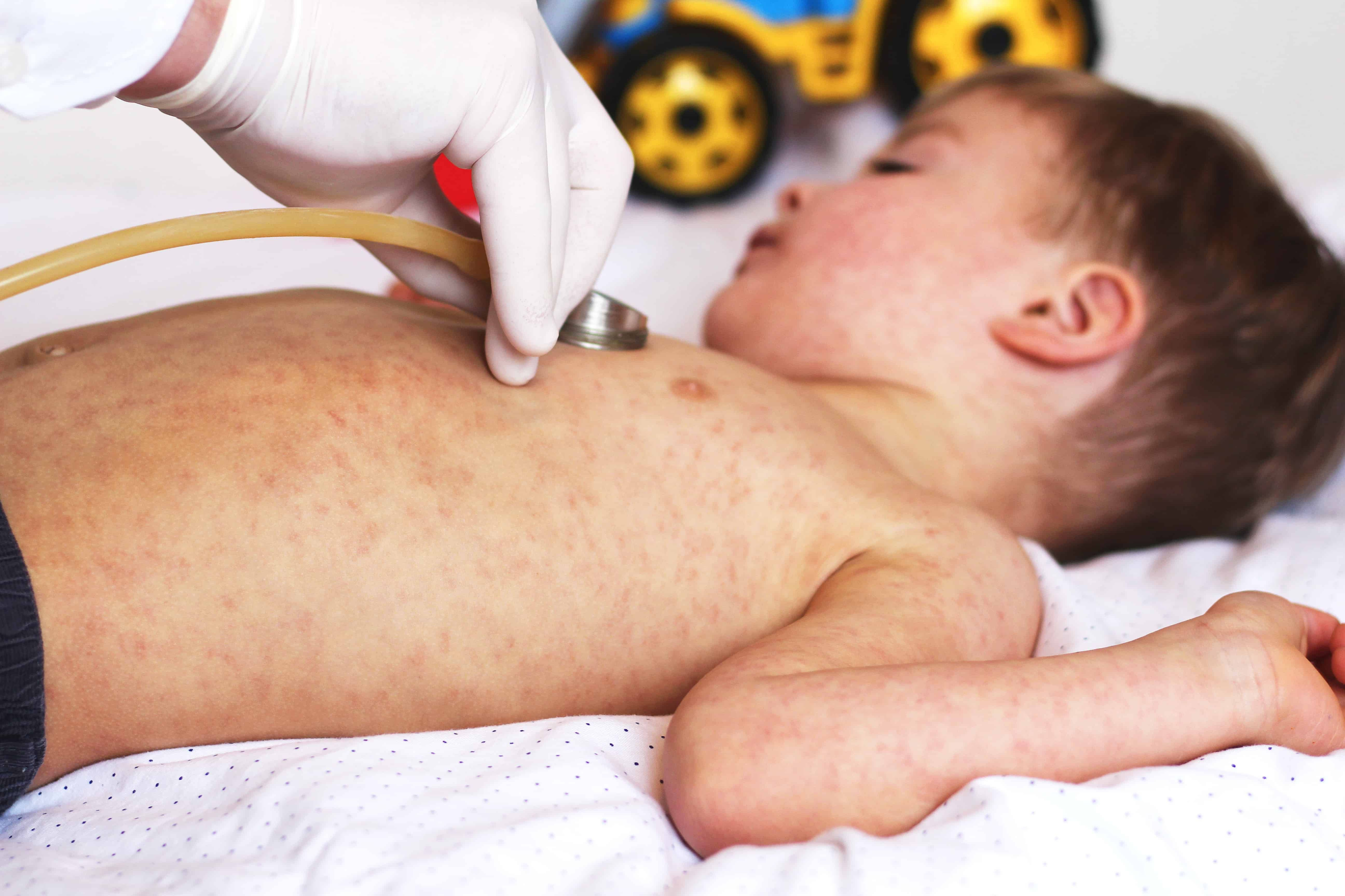 Measles Comeback Strips Away Four European Nations of Its 'Measles-free' Status