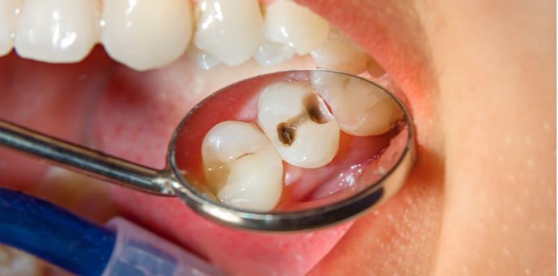 Anak Mengadu Sakit Gigi Sebab Berlubang? Ini Cara Mencegah Gigi Anak Rosak