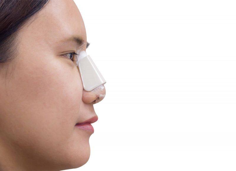 Hidung Mancung: Aplikasi Prosedur Rhinoplasty Bagi Tujuan Kecantikan Hidung