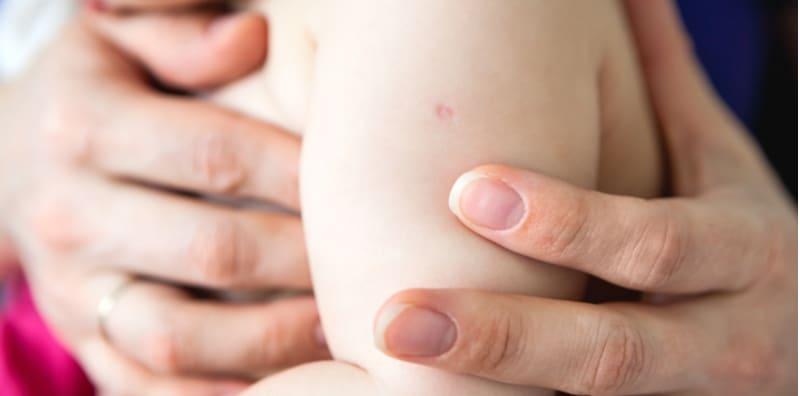 Parut BCG Di Lengan Kiri Petanda Pernah Terima Vaksin BCG?