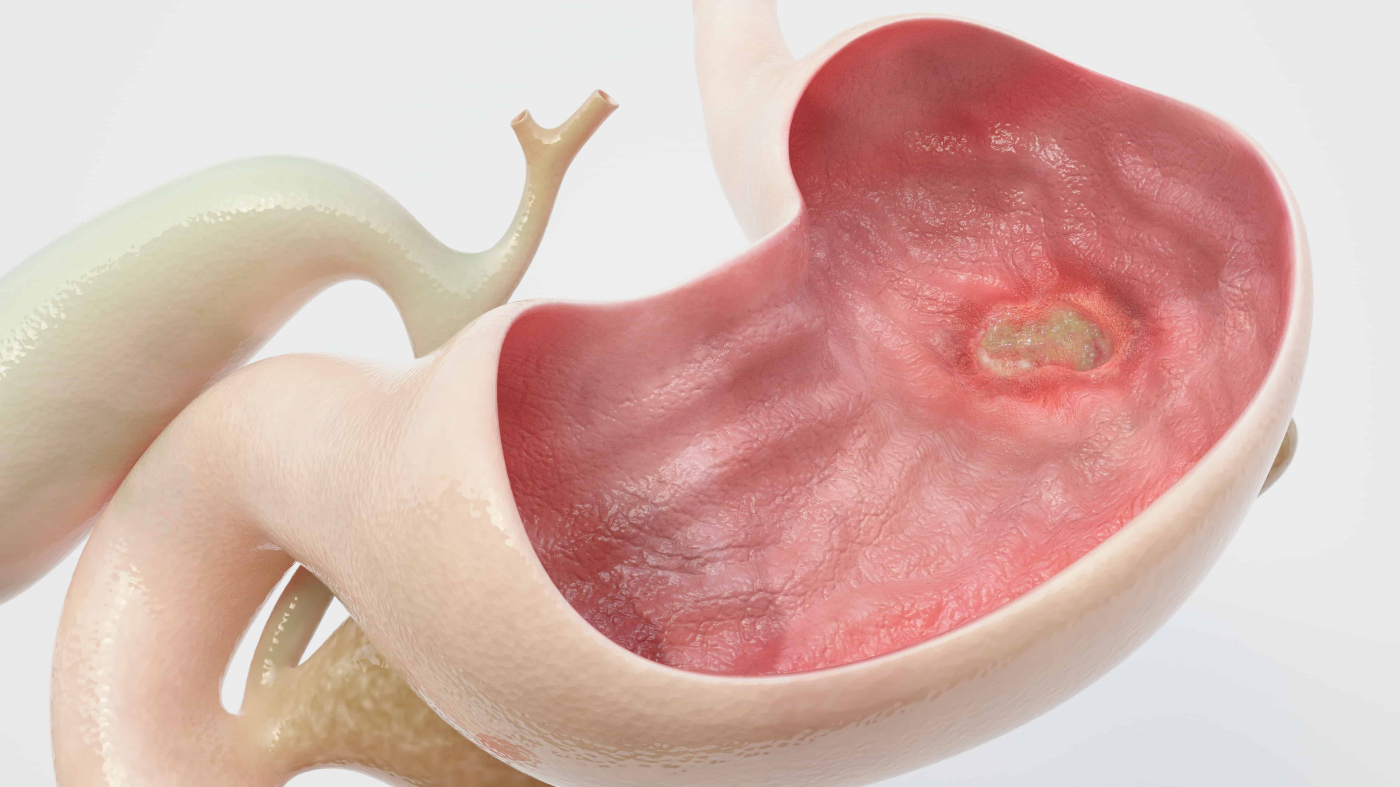 Peptic Ulcer Disease