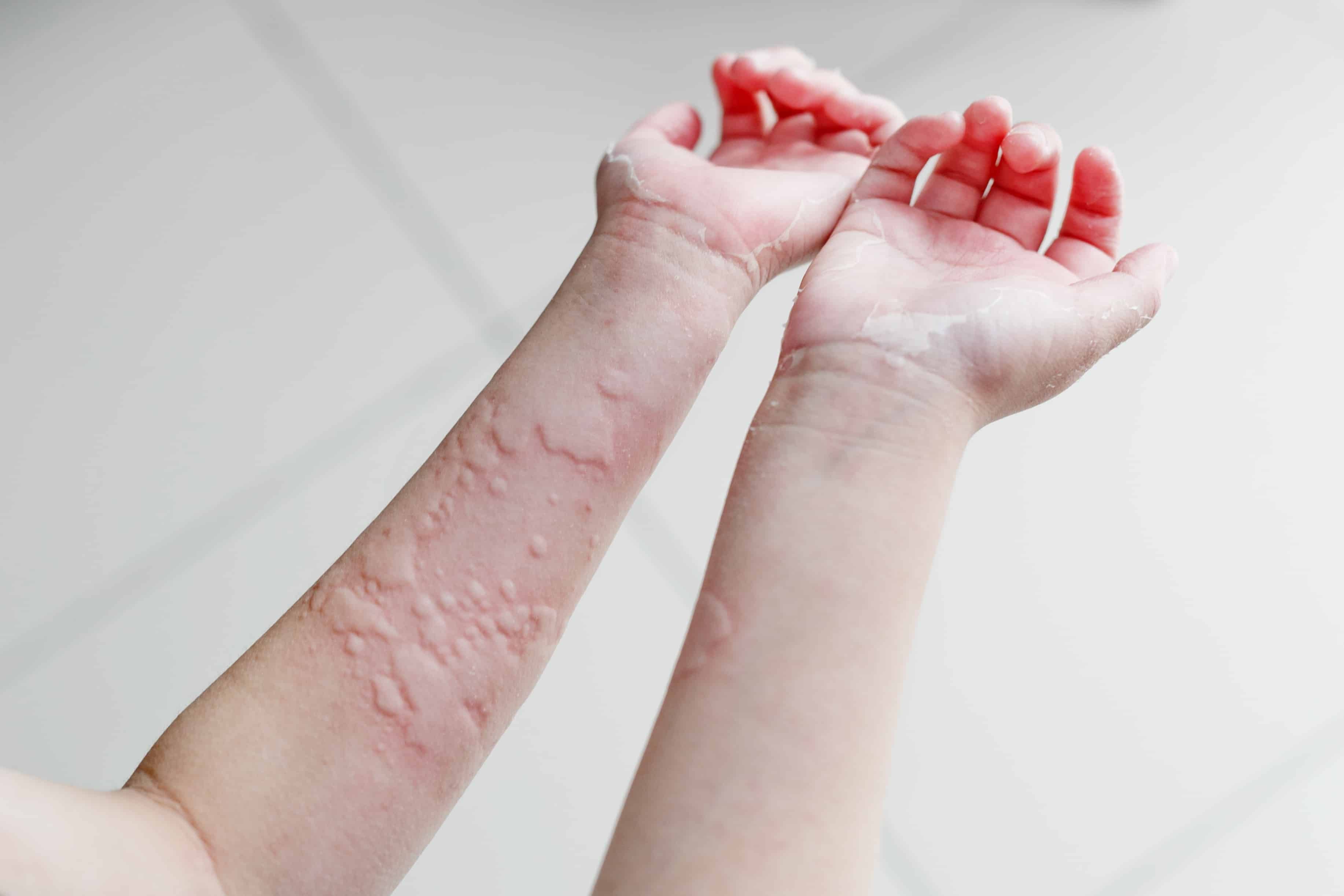 Understanding Urticaria