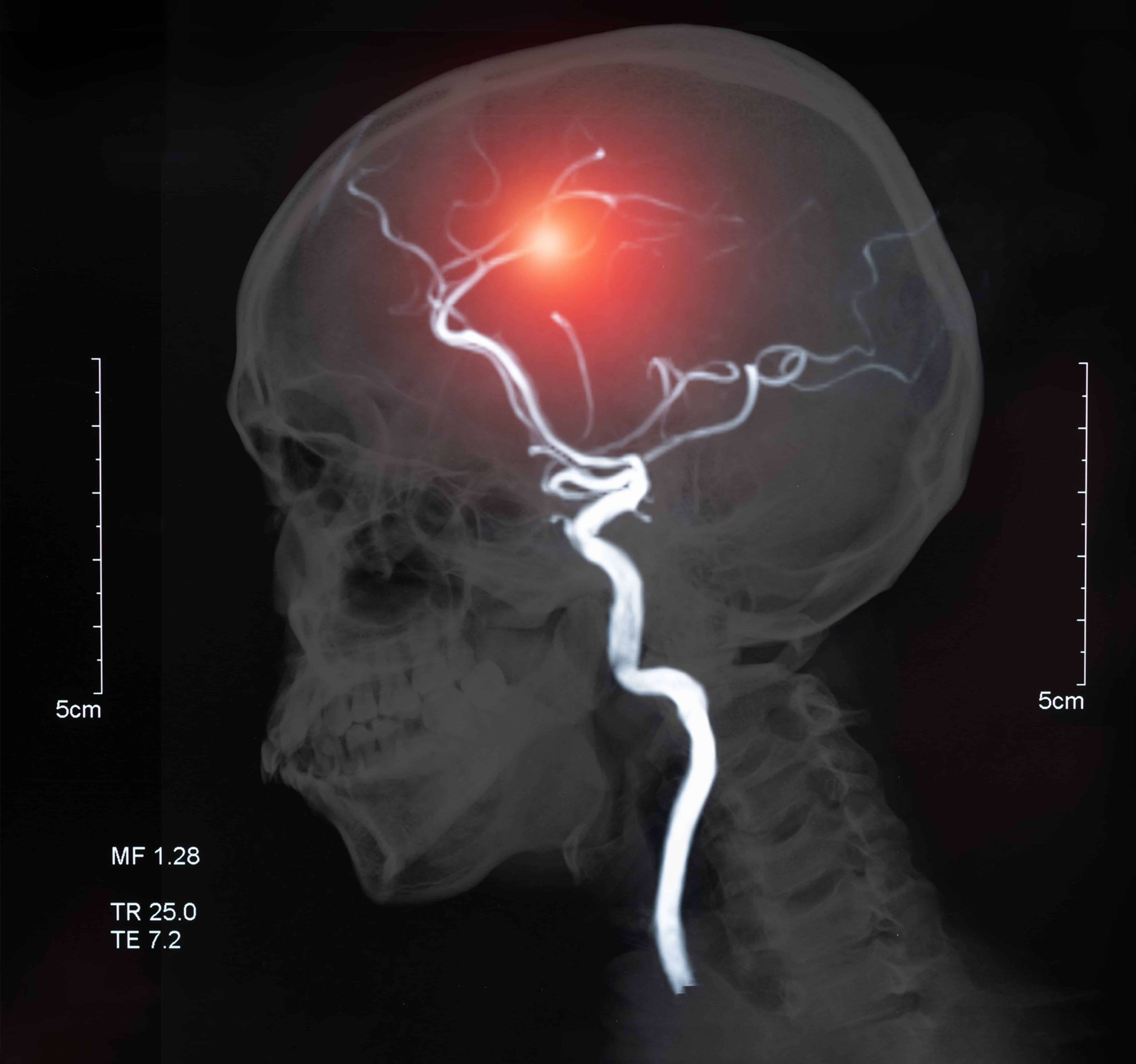 Cerebral Venous Thrombosis