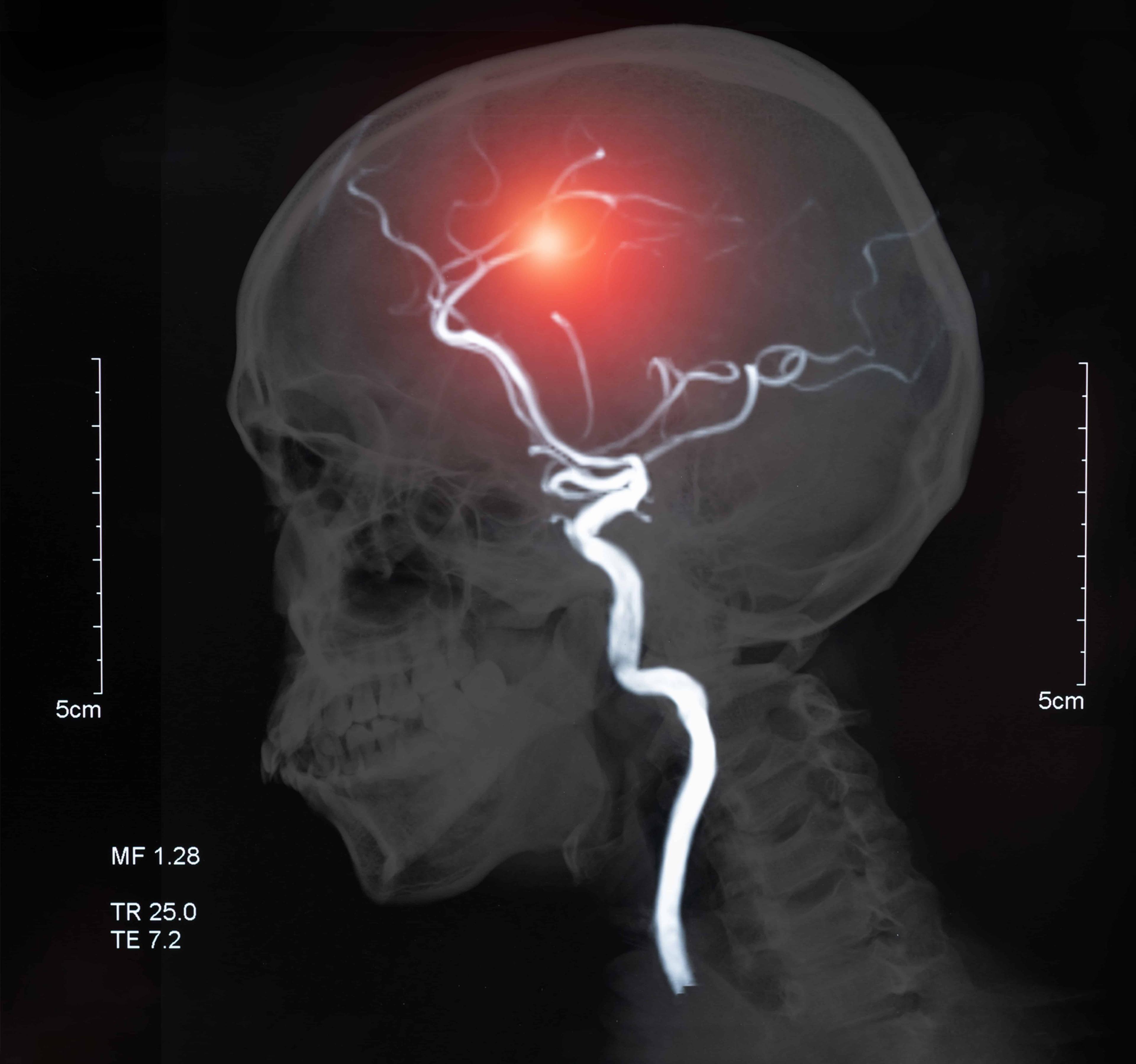 understanding-cerebral-venous-thrombosis