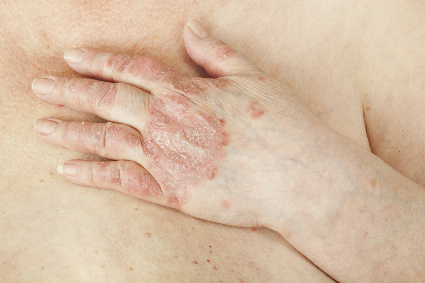 Sokongan Untuk Penghidap Artritis Psoriatik