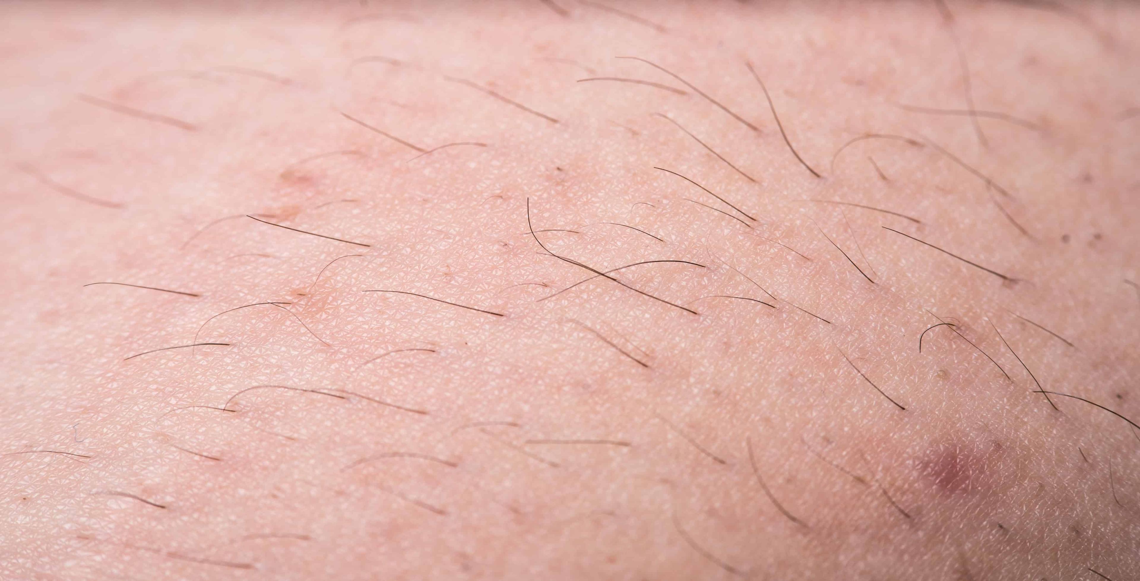 hormon-penyebab-bulu