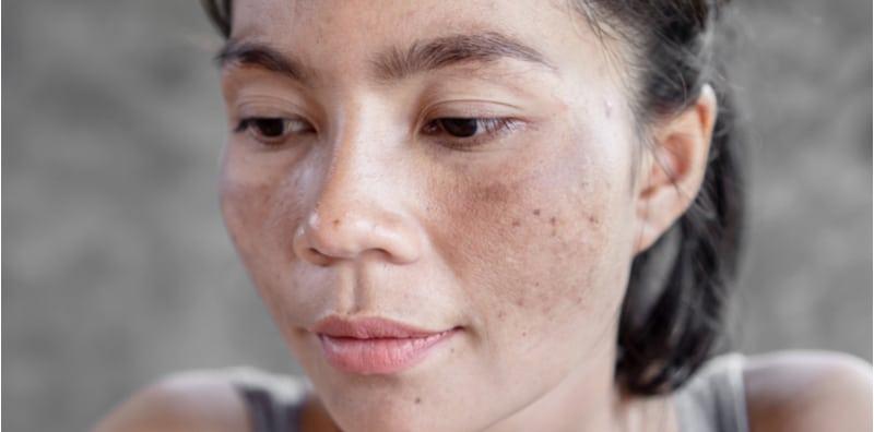 Cela Jeragat Susah Nak Hilang, Cuba Guna 8 Bahan Alami Ini Untuk Membantu