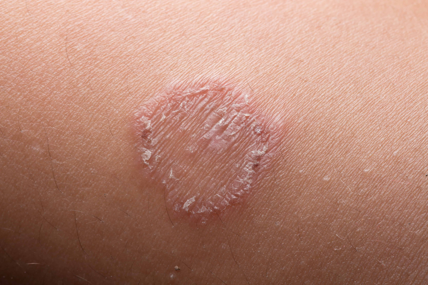 Ringworm (Tinea)