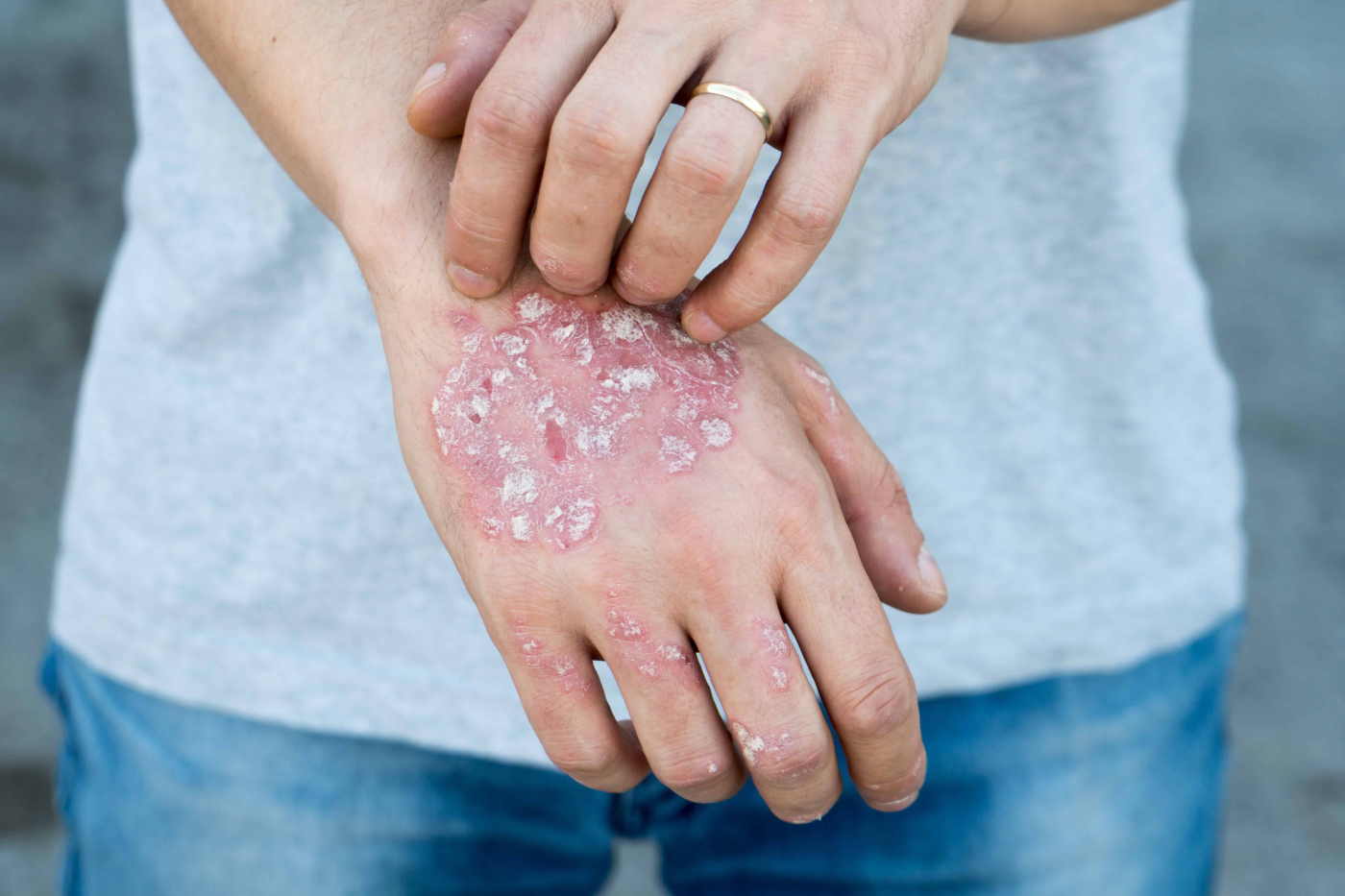 Ayuh, Mari Hapus Stigma Psoriasis!