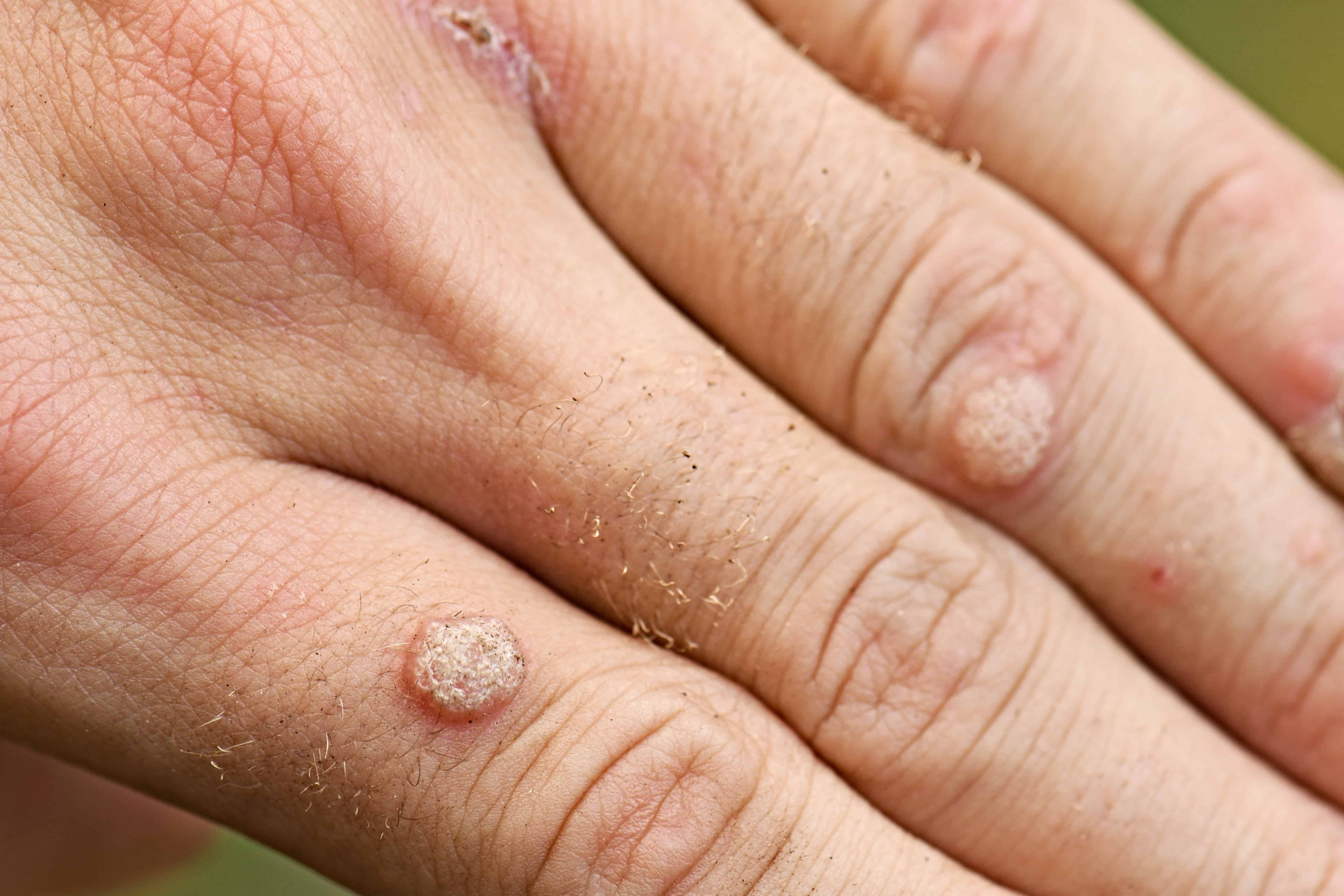 Warts: What You Need To Know