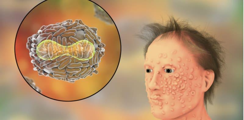 penyakit-yang-telah-lama-tidak-wujud