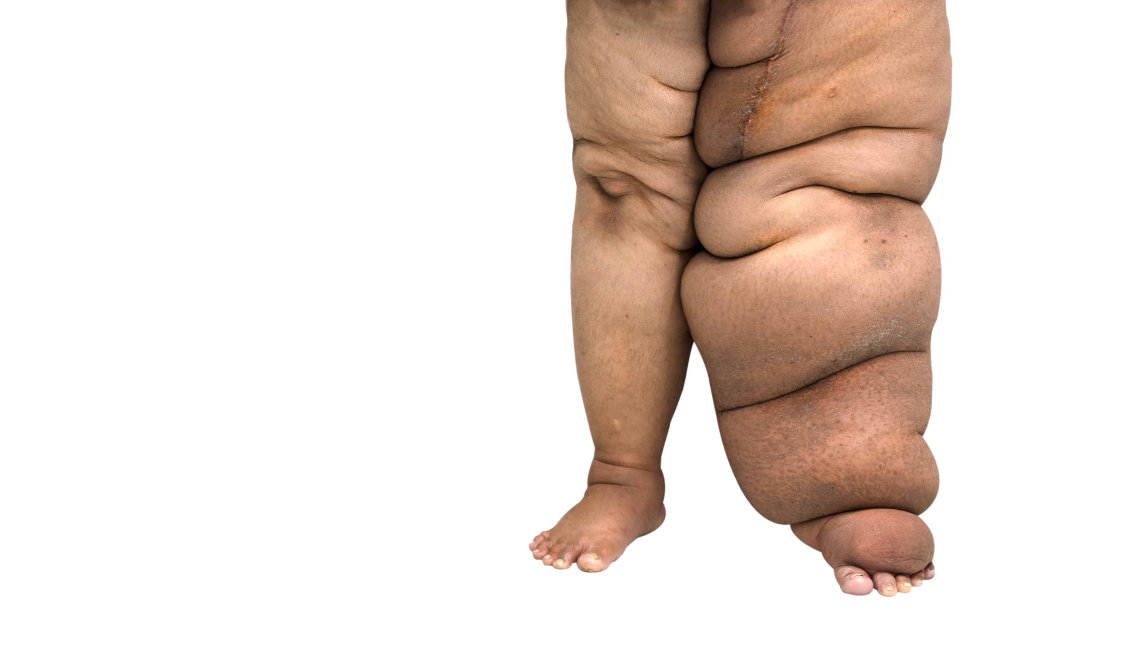 elephantiasis-penyakit-kaki-gajah-nyamuk