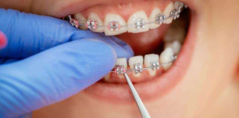Pakai Braces Untuk Gigi Tersusun Rapi, Tapi Berapa Lama Tempoh Memakai Pendakap Gigi?