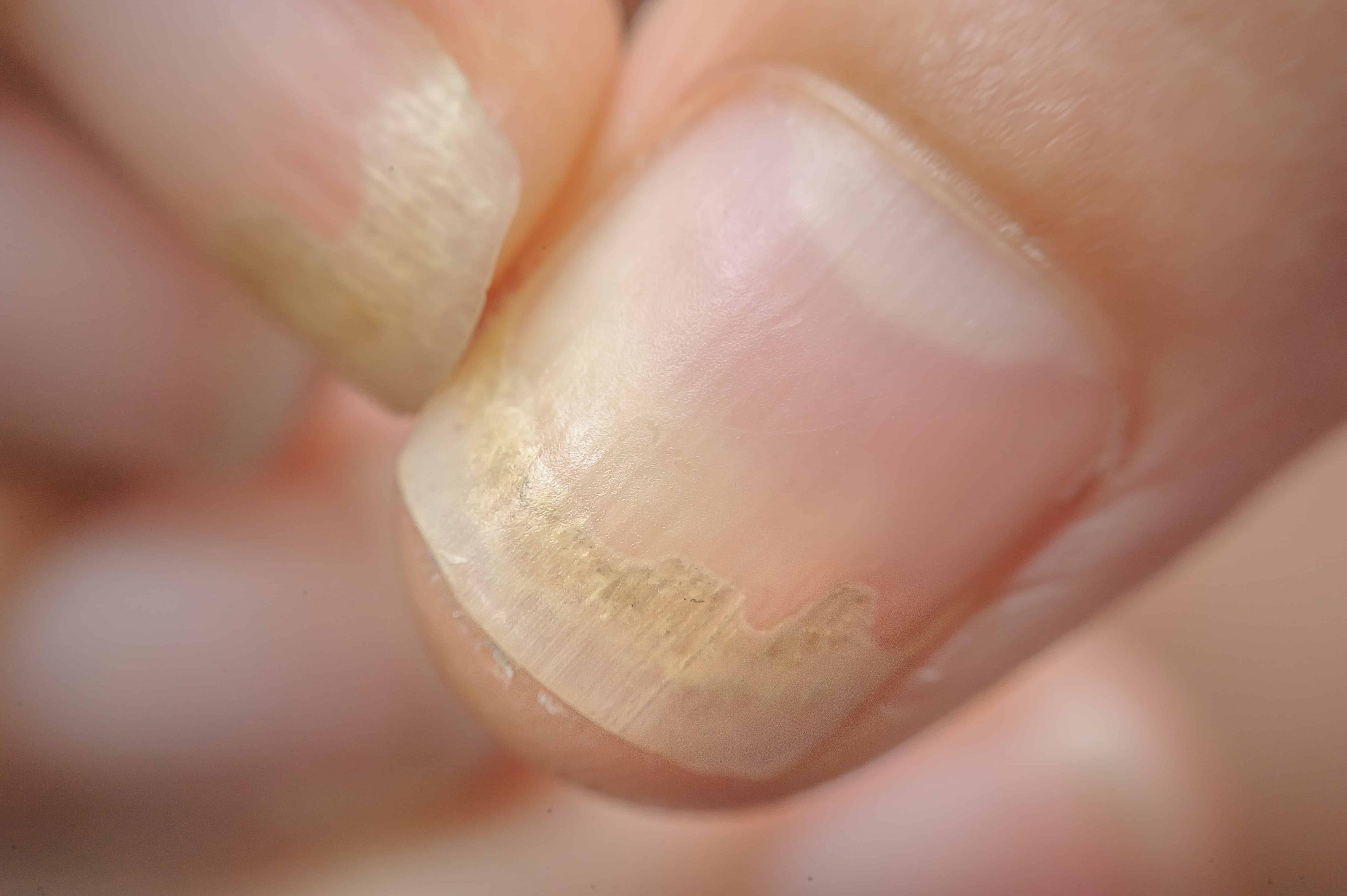 nail-disorders-health