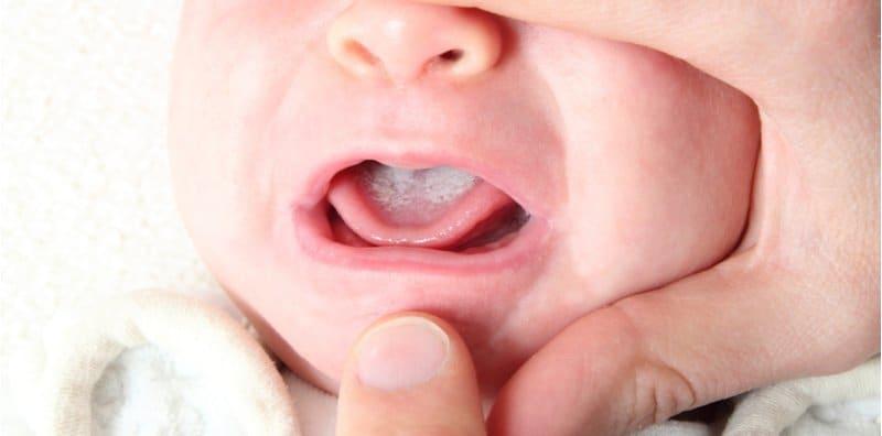 jangkitan-kulat-mulut-bayi