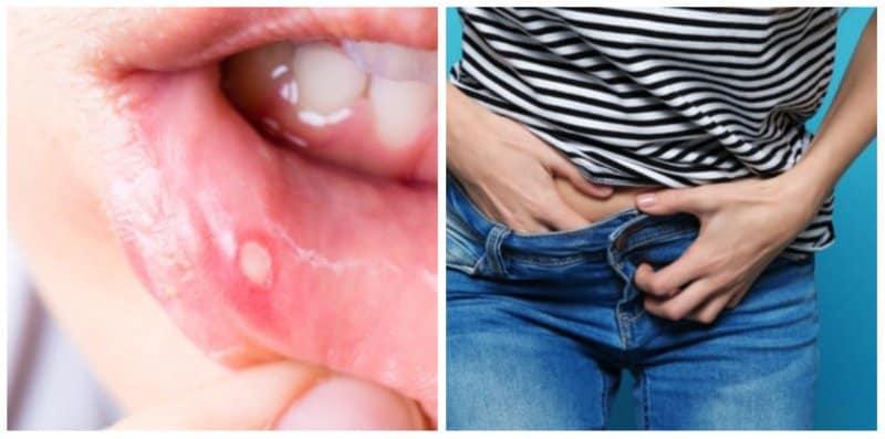 Hati-Hati Jika Anda Ada Gejala Ini Pada Badan, Ia Mungkin Petanda Sifilis!