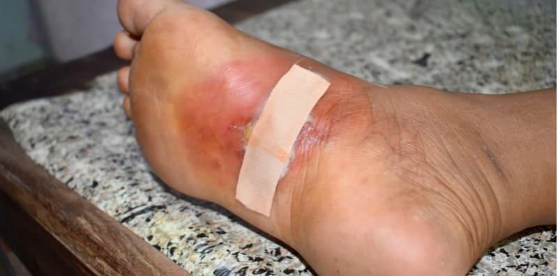 4 Langkah Penting Penjagaan Luka Kencing Manis! Jika Tidak Buat, Lambat Sembuh?