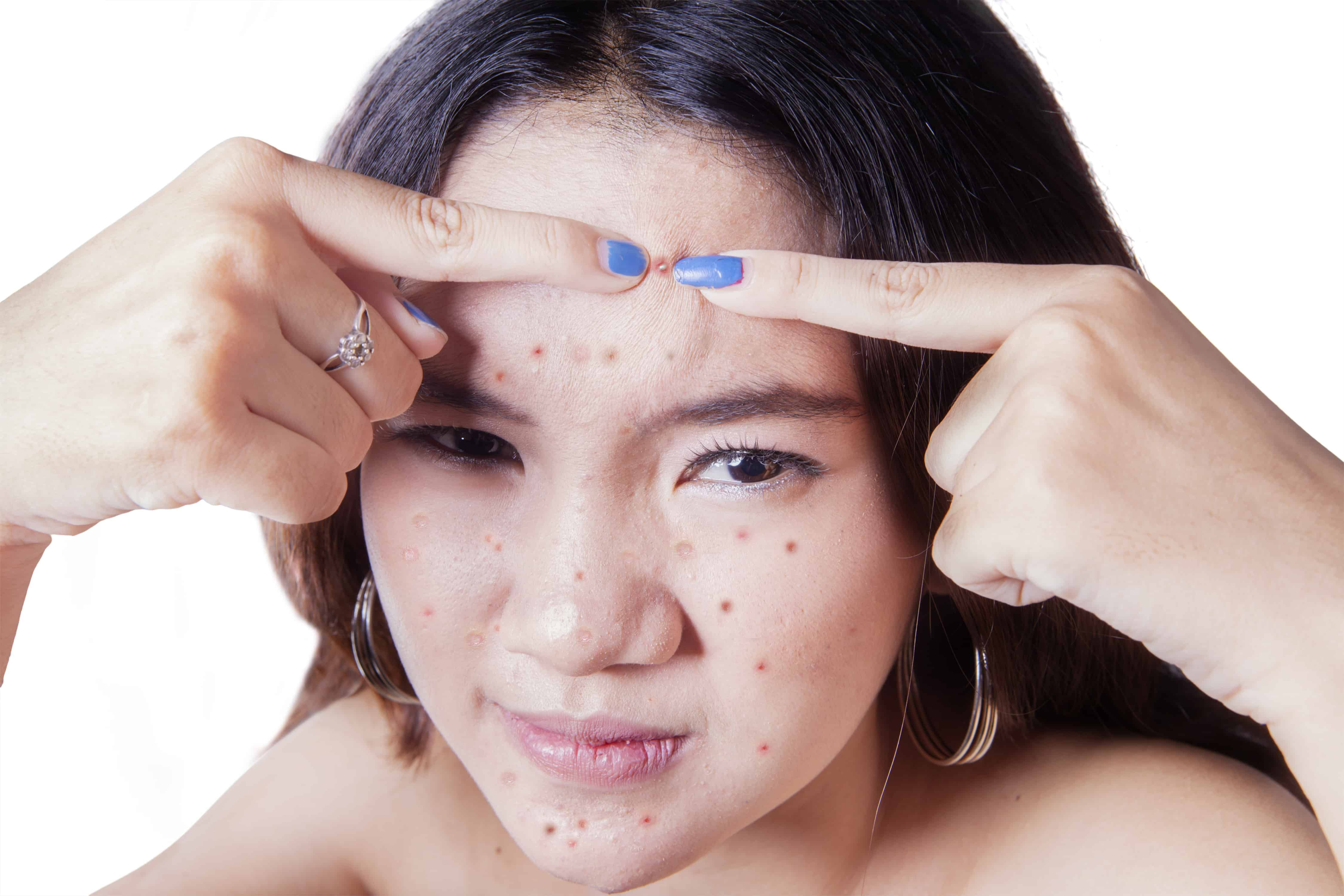 Top Tips for Teen Acne