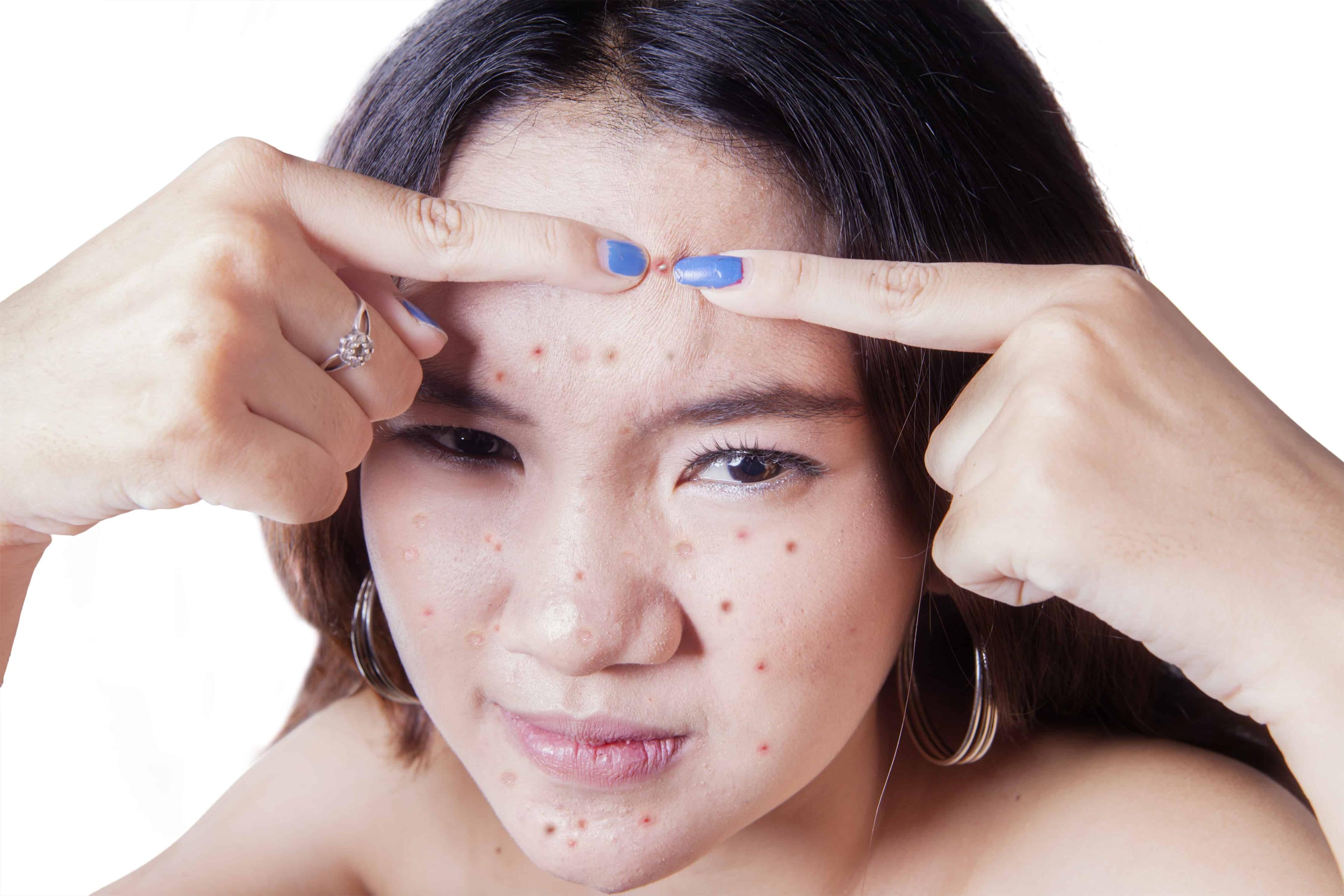 top-tips-for-teen-acne