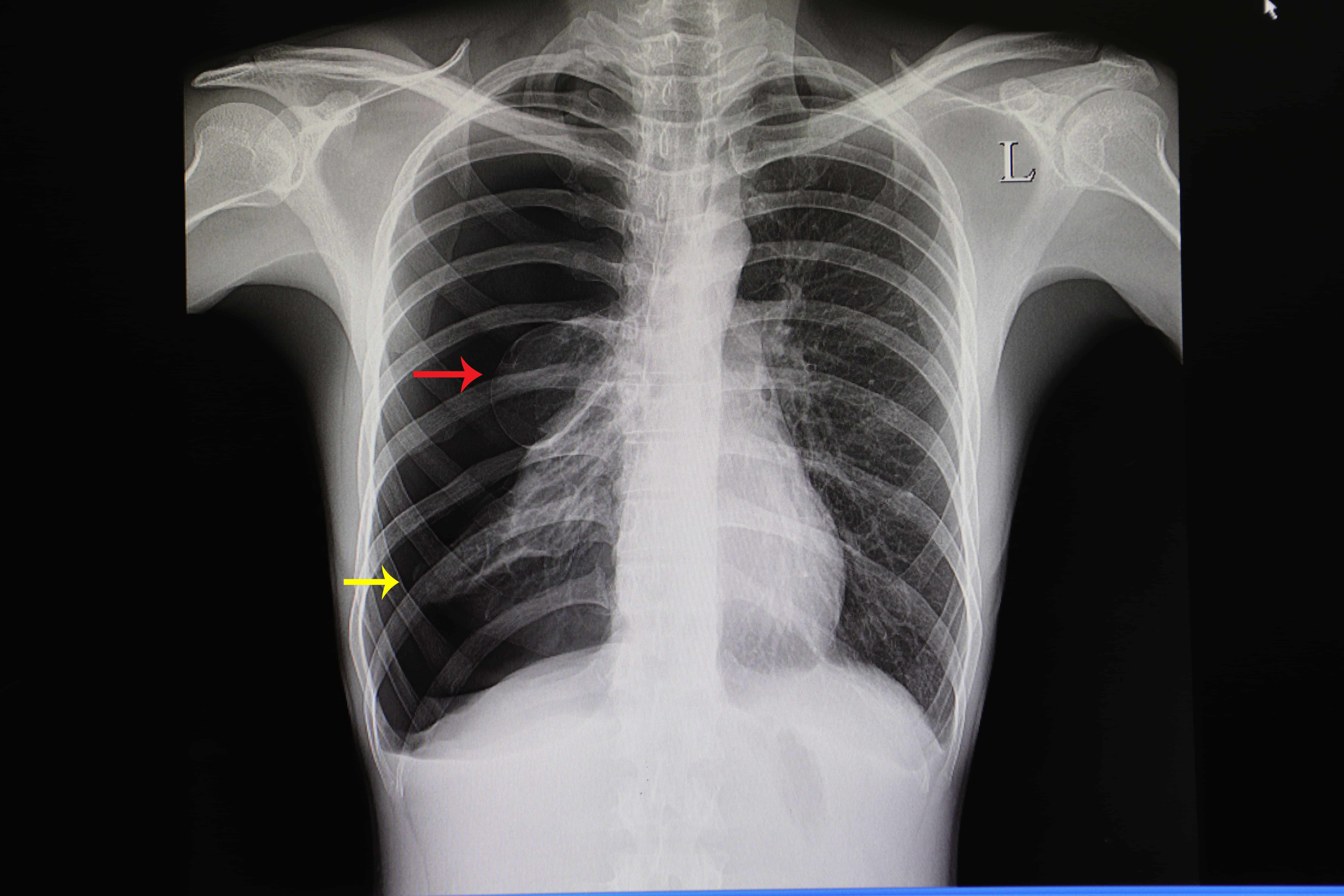 Pneumothorax