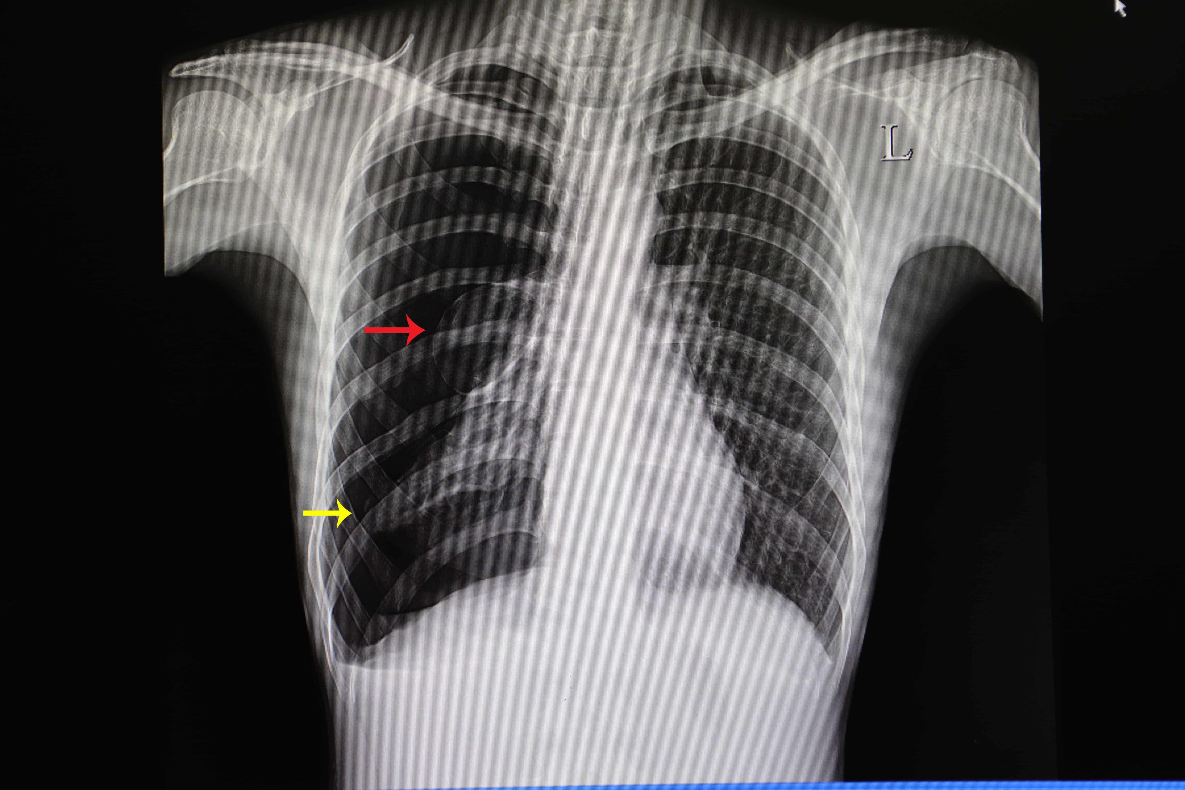 ketahui-pneumothorax