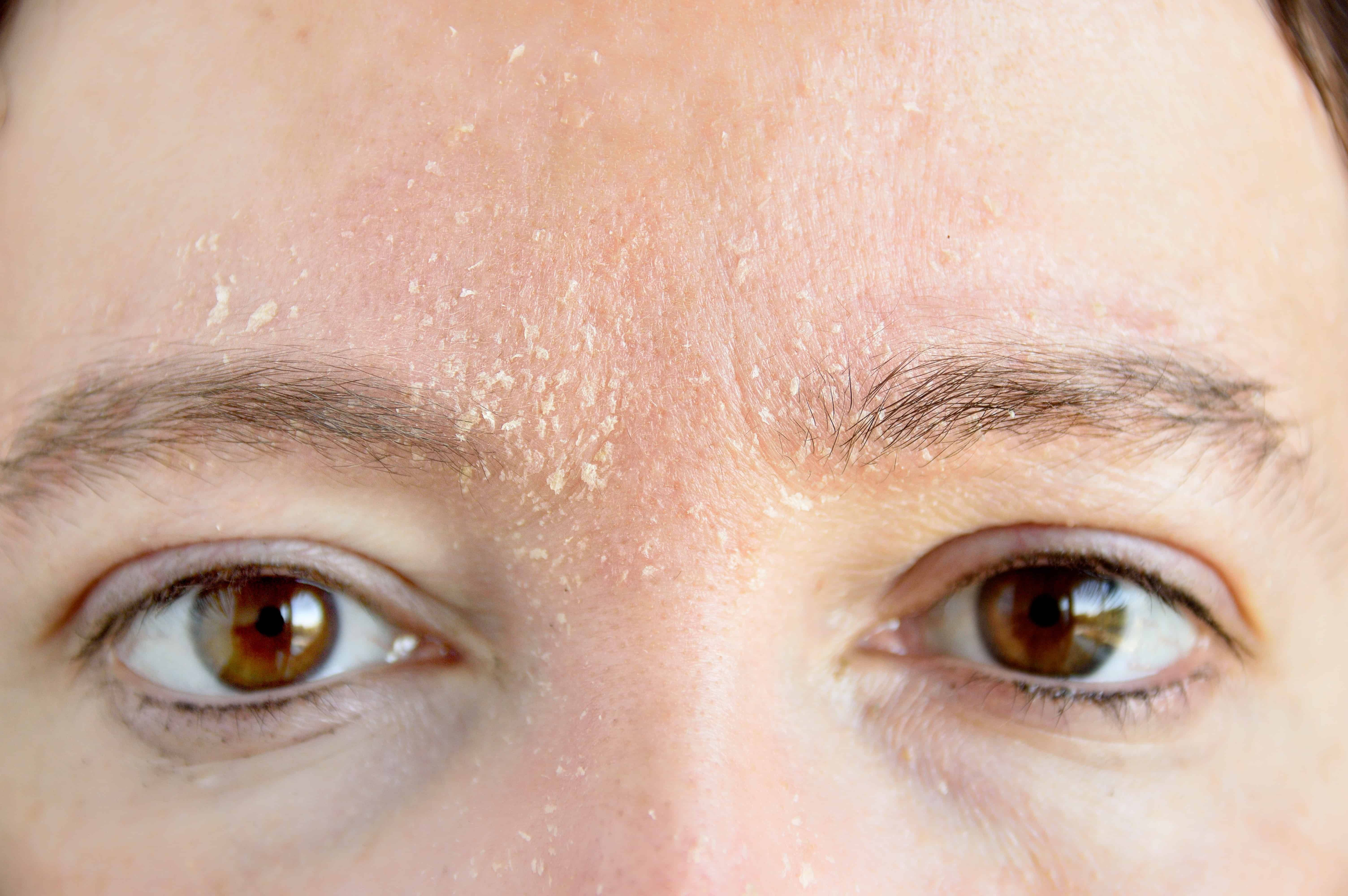All You Need to Know About Dry And Cracked Skin