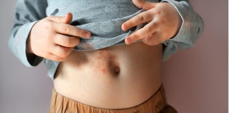 Anak Mengadu Tangan Jadi Gatal & Kemerahan, Itu Petanda Dijangkiti Kudis Buta