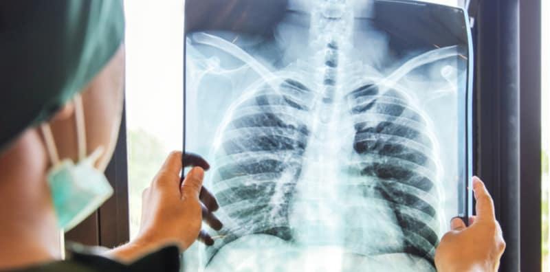 Bahaya Fenomena Hujan Asid, Ia Boleh Sebabkan Individu Alami Radang Paru-paru?