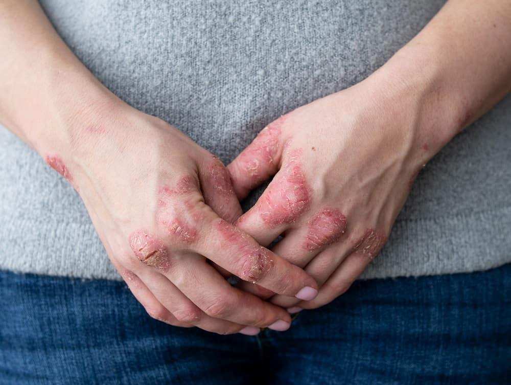 Jangan Risau! Ubat Biologik Selamat Dan Berkesan Merawat Masalah Psoriasis