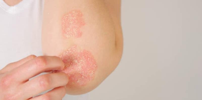 AWAS, Ini 5 Penyakit Kronik Berisiko Tinggi Terjadi Akibat Psoriasis Yang Tidak Dirawat!