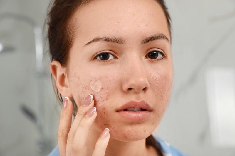 Boleh Ke Atasi Masalah Jerawat Dengan Pimple Patch? Jom Selidik Keberkesanannya