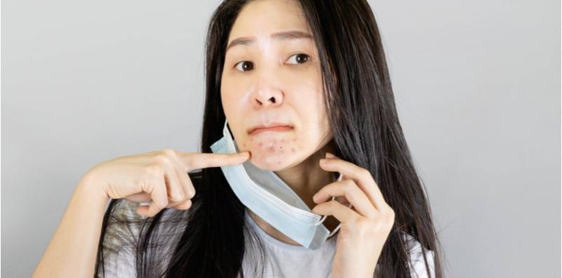 Ini 5 Jenis Masalah Kulit Yang Sering Berlaku Jika Terlalu Lama Pakai Topeng Muka!