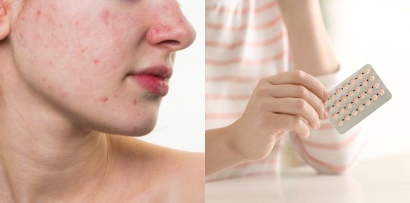 Nak Hilang Jerawat, Makan Pil Perancang: Sahih Ke Tidak?