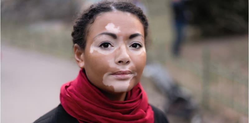 Tidak Berjangkit, Ini 3 Beza Penyakit Sopak Dan Albinisme, Jangan Takut Nak Dekat Ya