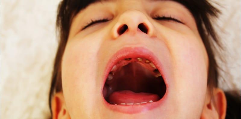 anak-gigi-rosak-cabut