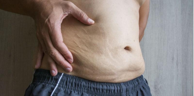 Jangan Tak Tahu, Lelaki Pun Boleh Ada Stretch Mark! Ini Penyebabnya