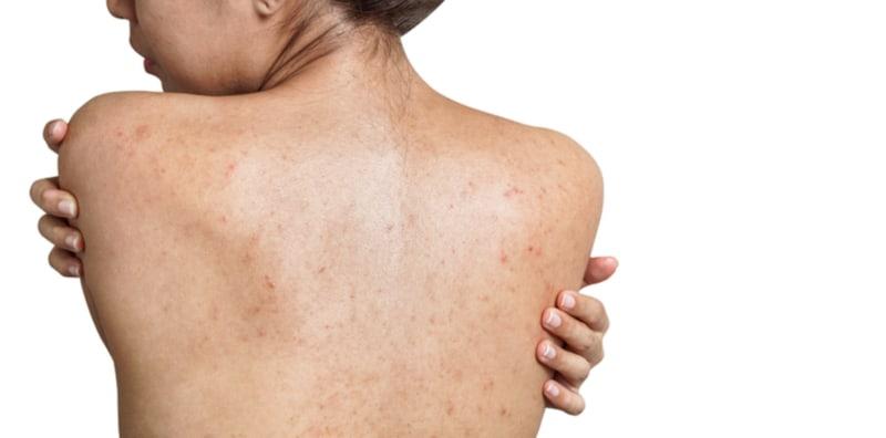 punca-jerawat-badan-muka