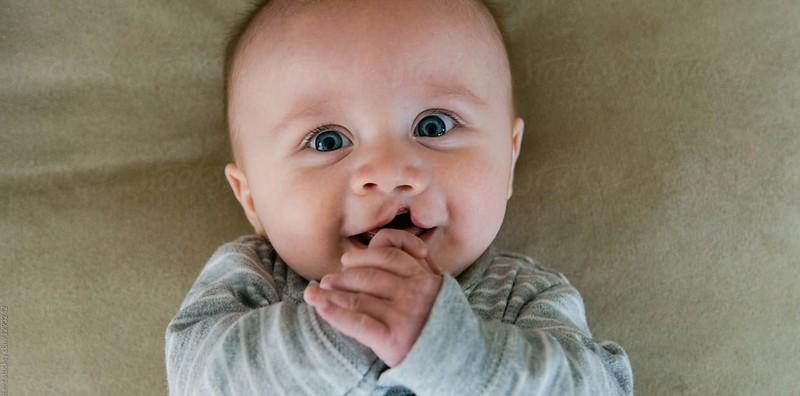 Ibu, Usah Bersedih Lagi! Sumbing Tak Bermakna Cacat Sepanjang Hayat