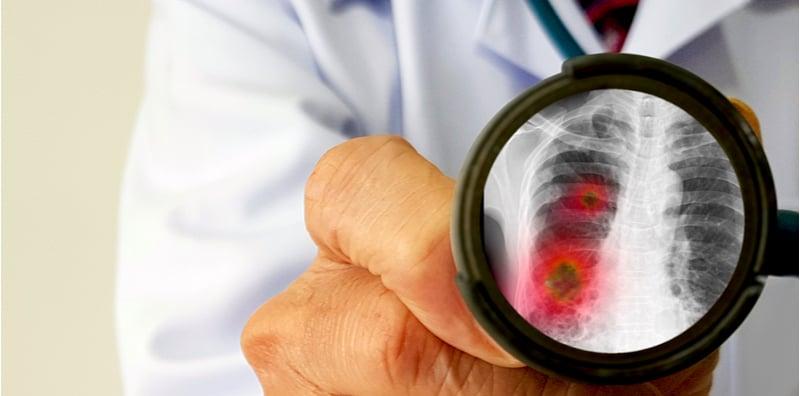 Pesakit COPD Mudah Terkena Pneumonia, Komplikasi Paling Bahaya Hingga Bawa Maut!