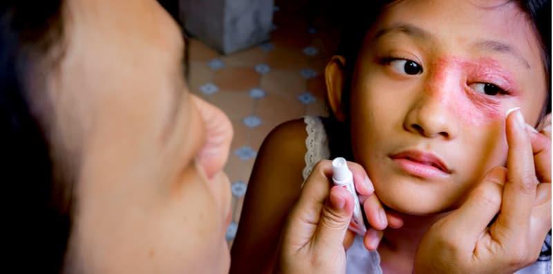 Jangan Terlebih Guna! Ubat Steroid Topikal Untuk Masalah Kulit Ada Kesan Sampingan