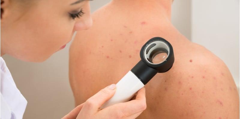 Ingat Muka Saja Yang Tumbuh Jerawat, Rupanya Badan Pun Boleh Kena, Ini Puncanya!