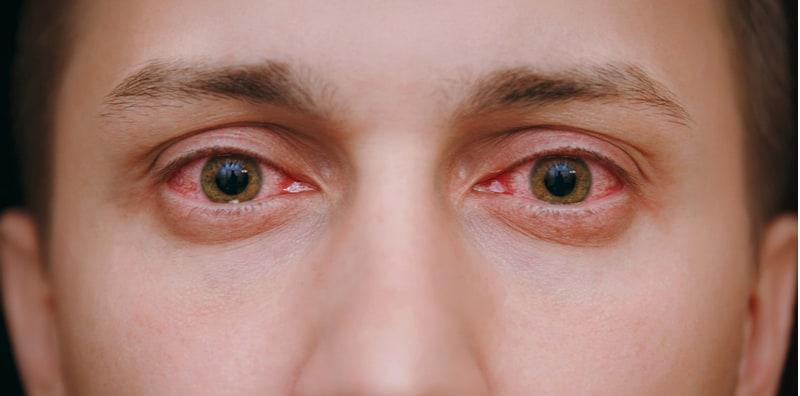 Jangan Terkeliru Ya, Herpes Mata Tak Sama Dengan Konjunktivitis! Ini Bezanya