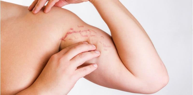 Jangan Pelik Jika Ada Stretch Mark Pada Bahu, Ia Boleh Muncul Di SEMUA Tempat! Ini Puncanya