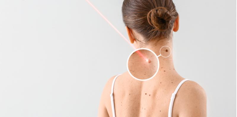 Rimas Tengok Ketuat Pada Badan? Ini Cara Merawatnya, Mudah Saja, Hanya Perlu Buat Di Rumah!