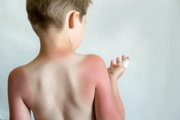 Anak Gemar Main Panas? Ini 5 Cara Nak Elakkan Sunburn Pada Si Kecil, PASTI BERKESAN!