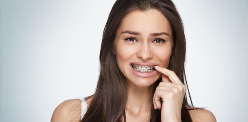 Trend Pemakaian Braces Terhad Untuk Orang Muda Saja Ke? Tak Sesuai Untuk Golongan Berusia?