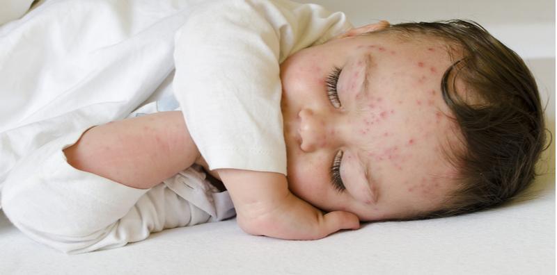 Anak Kena Chickenpox? Nah, Cuba Rawatan Semula Jadi Ini Di Rumah, Pasti Berkesan!