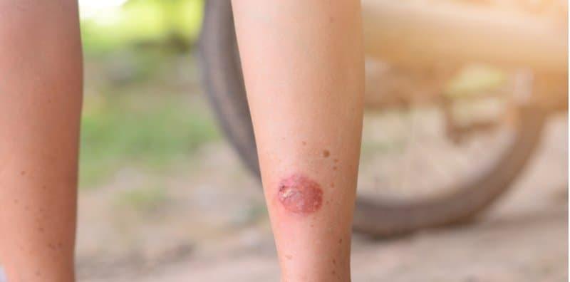 cara-merawat-luka-melecur-ekzos