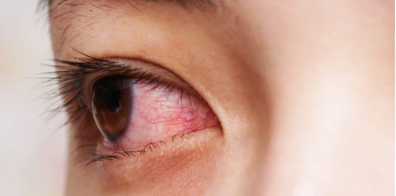 sakit-mata-boleh-berjangkit