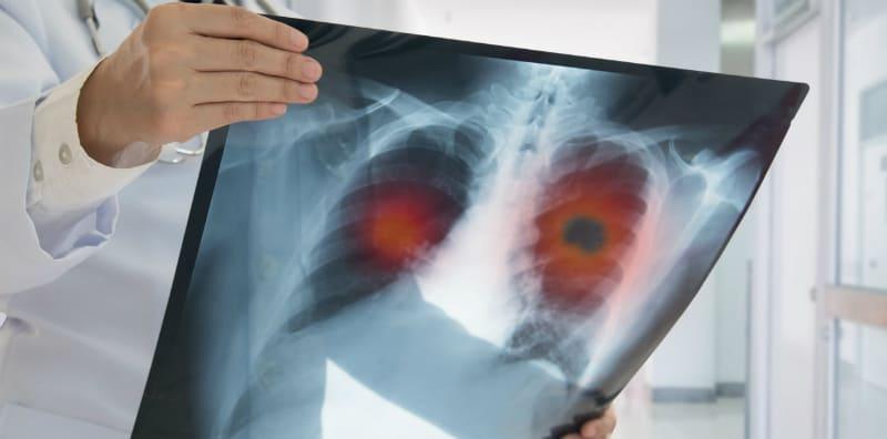 cara-merawat-radang-paru-paru